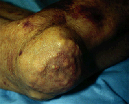 Lắng đọng urat làm cho hình thành các tôphi dưới da và gây nên bệnh khớp mạn tính do urat.