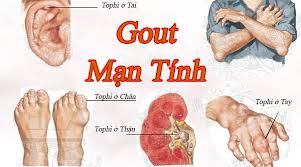 Hình ảnh minh họa bệnh gout