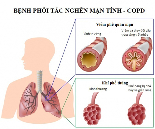 Bệnh phổi tắc nghẽn mãn tính - COPD