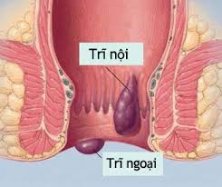Trĩ nội, trĩ ngoại