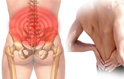 Nguyên nhân hội chứng đau mỏi thắt lưng