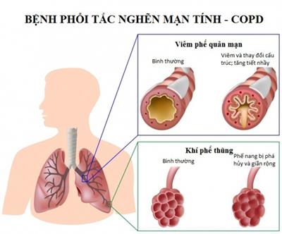 Bệnh phổi tắc nghẽn mạn tính - COPD