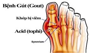 Chẩn đoán và điều trị gút (Gout)